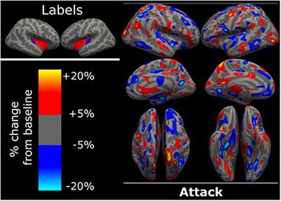 Cortical Activity During an Attack of Ménière's Disease—A Case Report